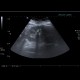 Nephrolithiasis, kidney stone: US - Ultrasound
